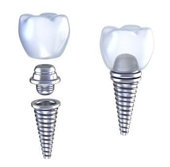 Computer generated image of Dental Implants at Jon C. Packman DDS Computer generated image of Dental Implants at Jon C. Packman DDS