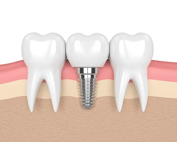 Image of a dental implant at Jon C. Packman DDS in Statesville, NC.